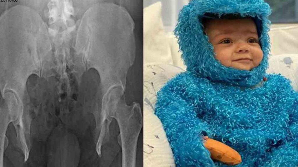 ¿Qué es la Extrofia Cloacal?, enfermedad que padecía el hijo de ‘Sopitas’