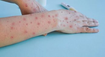 Quintana Roo refuerza medidas preventivas contra la viruela del mono en centros de trabajo tras aumento de casos