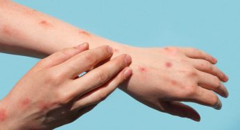 México supera los 5 mil contagios de sarampión