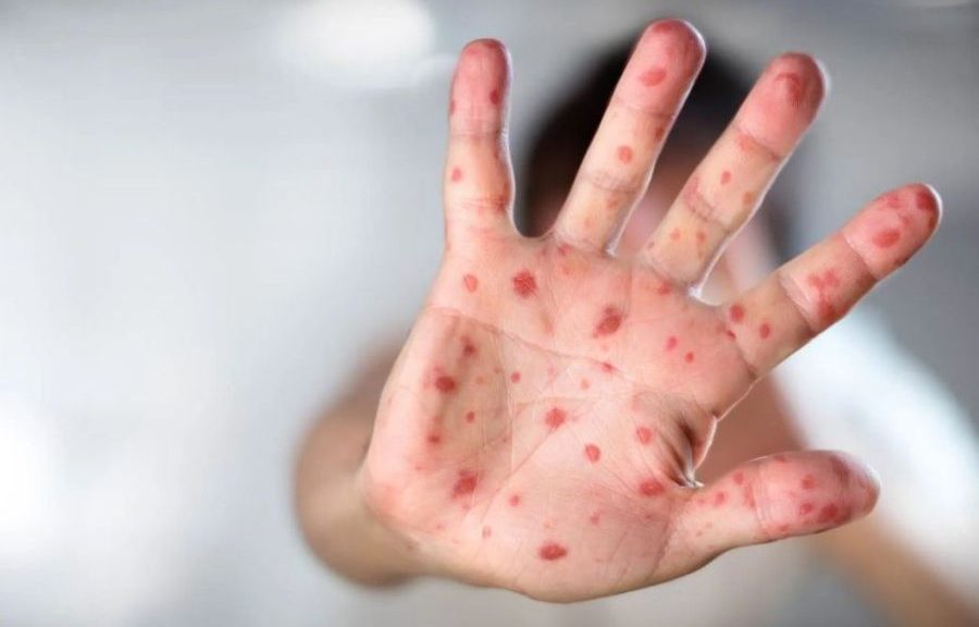 México suma 29 muertes por sarampión; brote activo en las 32 entidades