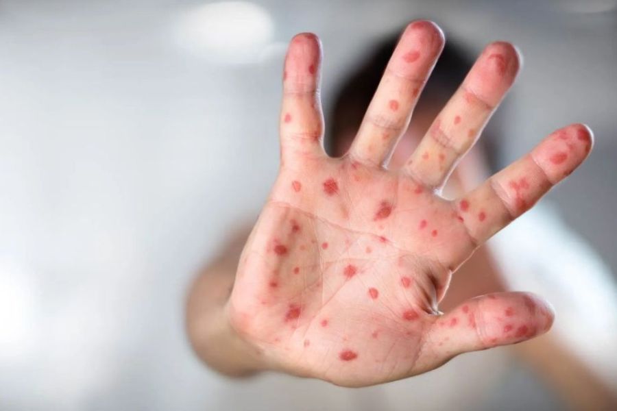 México suma 29 muertes por sarampión; brote activo en las 32 entidades