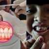 Alertan por aumento de casos de gingivitis en niños de Quintana Roo