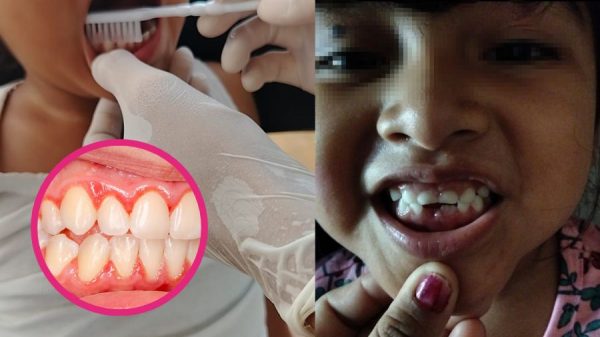Alertan por aumento de casos de gingivitis en niños de Quintana Roo