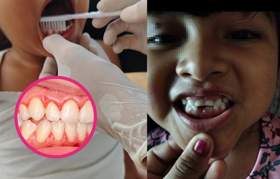 Alertan por aumento de casos de gingivitis en niños de Quintana Roo