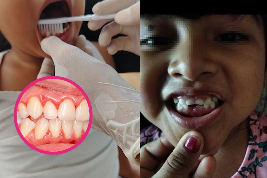 Alertan por aumento de casos de gingivitis en niños de Quintana Roo